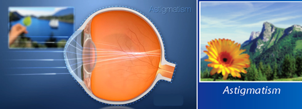 astigmatism 01 new